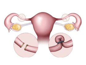 OTB o salpingoclasia en Guadalajara